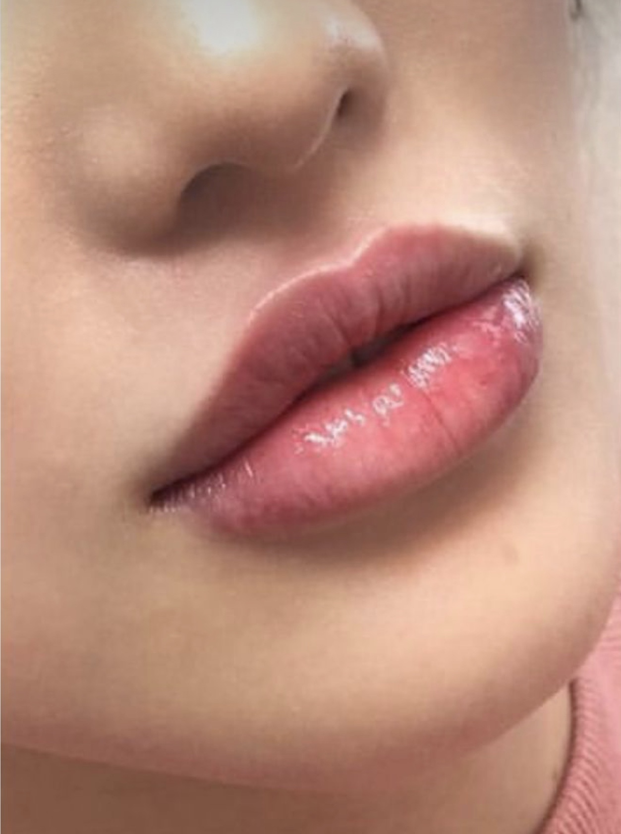 PureMD: Lip filler Experience